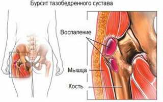 Трохантерит тазобедренного сустава: 6 способов оказания помощи