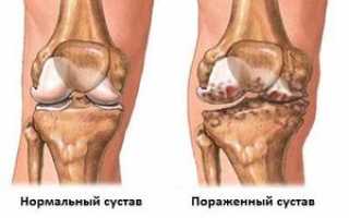 Есть ли шанс вылечить гонартроз 2 степени или ваши мучения навсегда