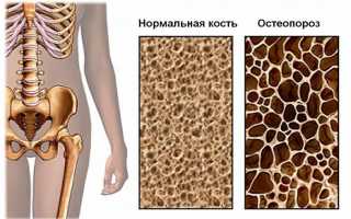 Почему ломается шейка бедра или остеопения тазобедренного сустава