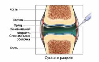 Жидкость в колене: причины, симптомы, принципы лечения