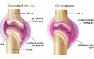 Как лечить остеоартроз колена?