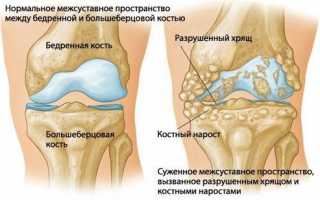 Как лечить остеохондроз коленного сустава?