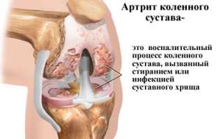 Лечение реактивного артрита коленного сустава