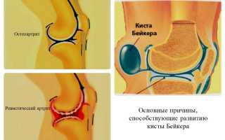 Еще про лечение кисты Бейкера