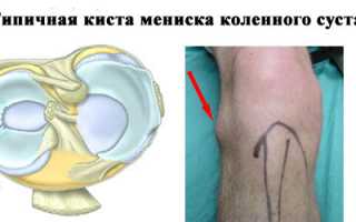 Киста мениска
