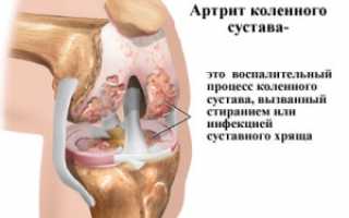 Как распознать артрит колена