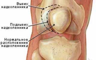 Вывих надколенника: привычный и врожденный