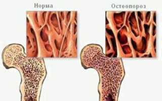 Что делать если у вас остеопороз коленного сустава