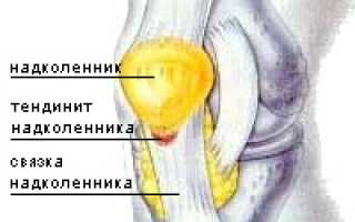 Тендинит, тендиноз и колено прыгуна