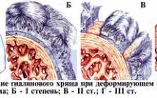 Деформирующий остеоартроз и его степени: можно ли уберечься?