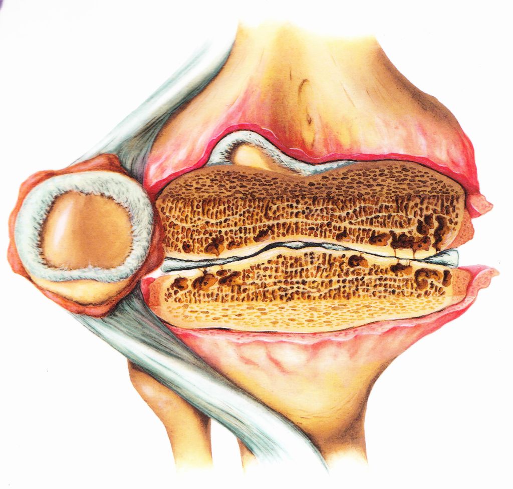 Схема артрита колена