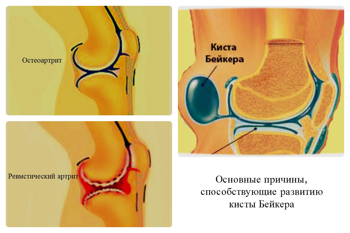 Причины кисты Бейкера