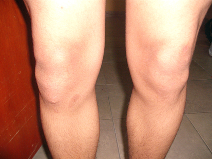 Проявление болезни Осгуда-Шлаттера Проявление болезни Осгуда-Шлаттера