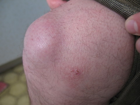 Препателлярный бурсит коленного сустава