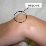 Гигрома коленного сустава