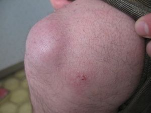 Хронический синовит