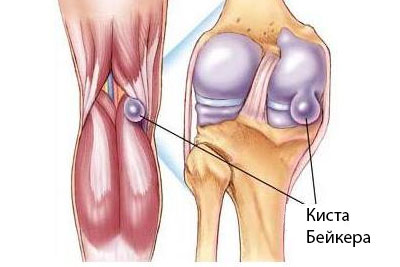 Киста Бейкера коленного сустава