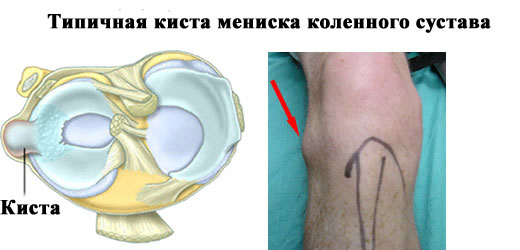 Киста мениска коленного сустава