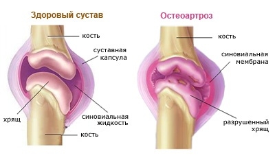 Остеоартроз коленного сустава