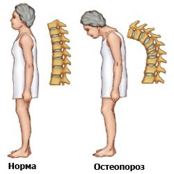 Остеопороз и норма