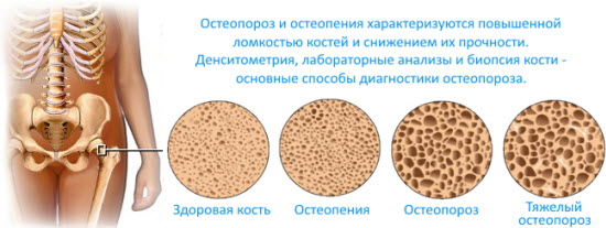 Разница между остеопенией и остеопорозом на примере костной ткани