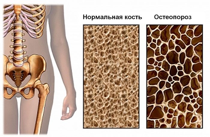 Признаки и симптомы остеопении