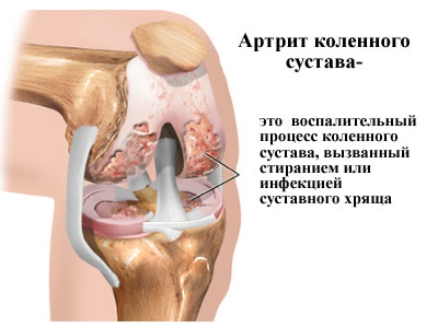 Артрит колена