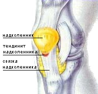 Тенденит коленного сустава