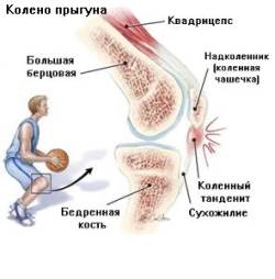 Тенденит или колено прыгуна