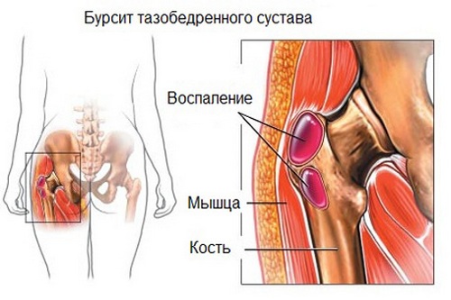Схематичное изображение вертельного бурсита