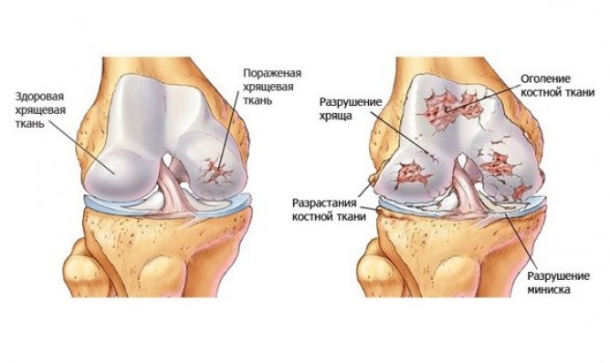 Поражения хрящевой ткани