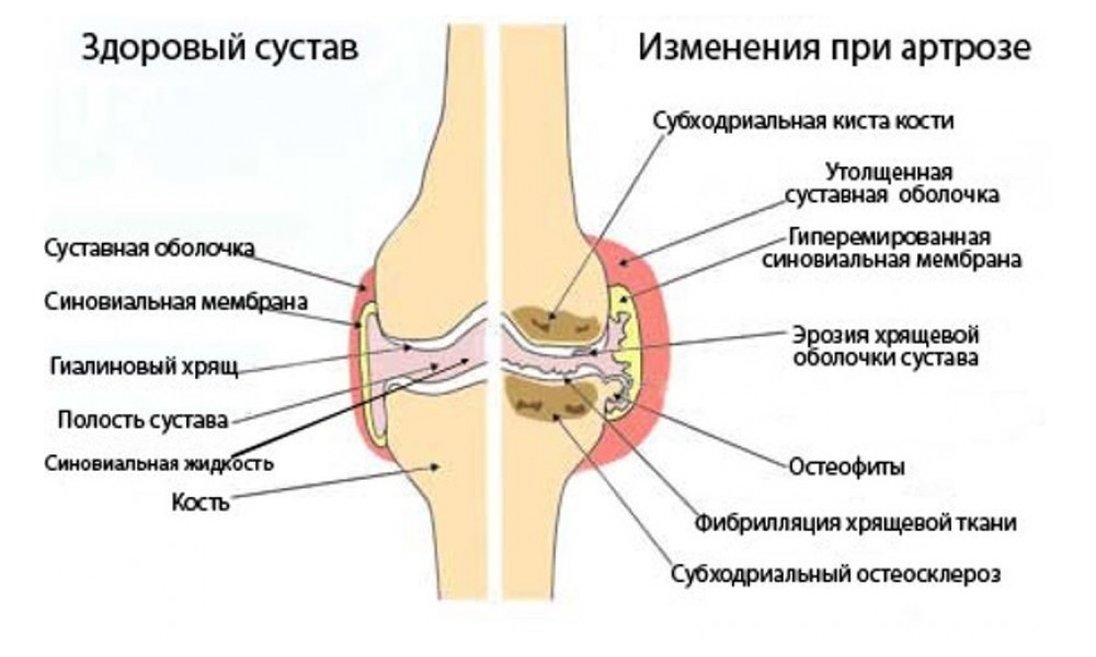 Изменения хрящевой ткани при артрозе