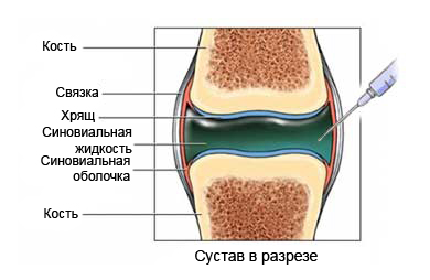 Жидкость в коленном суставе